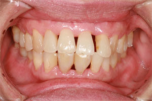Gum Recession Beverly Hills: Gum recession is not something you would want to ignore. Make an appointment with